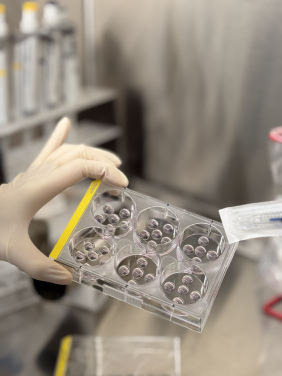 The HKUMed research team grew a collection of 70 organoids from tissue samples of cancer patients at Queen Mary Hospital, providing a realistic model for studying the progression of intestinal metaplasia to cancer.
 